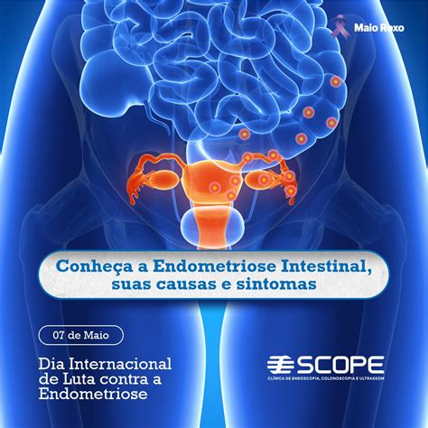 endometriose intestinal